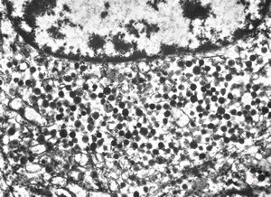 F,45y. | metastasis - carcinoid